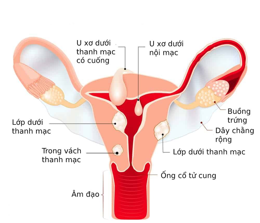 Xóa mờ cổ tử cung